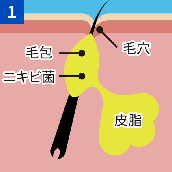 面皰ができる