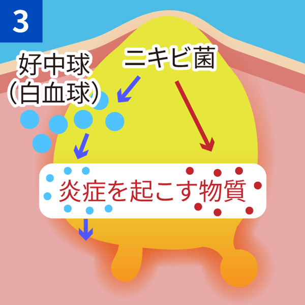 炎症が起きる