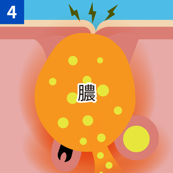 さらにひどくなるとしこりなどへ