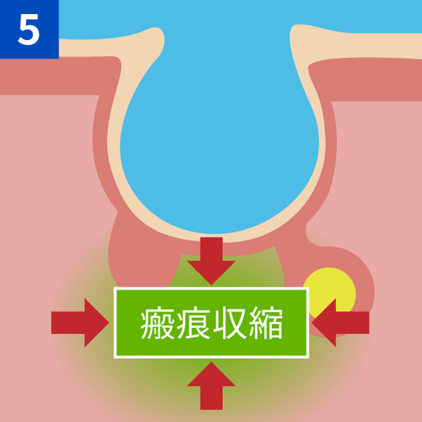 瘢痕形成