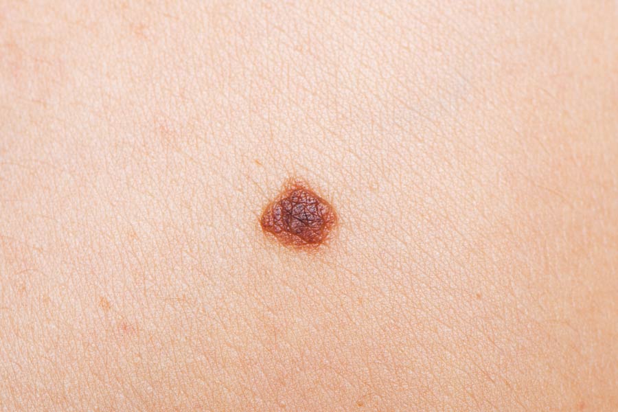 ほくろ取り（手術による切除）