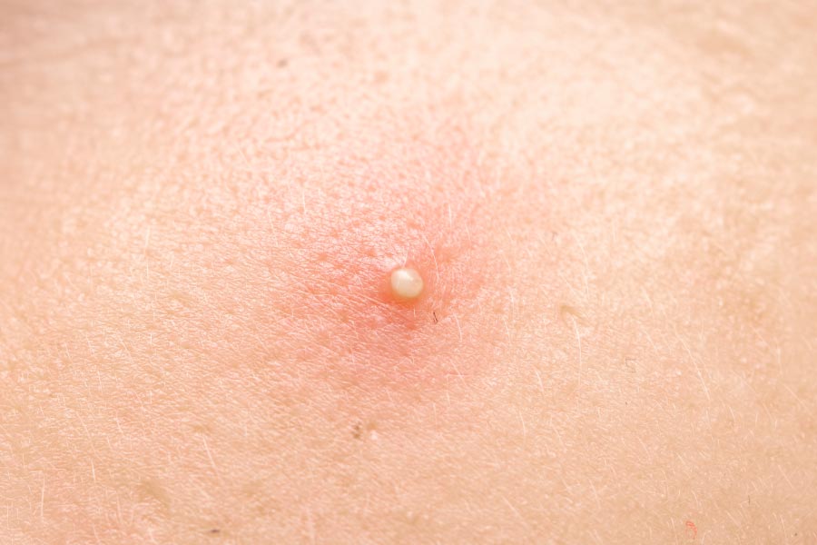 ニキビ・肌荒れ