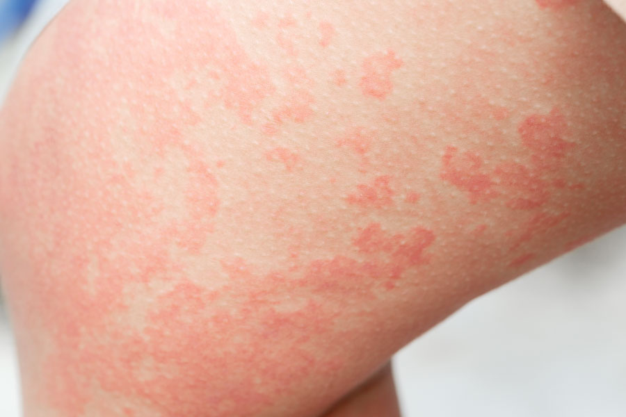 蕁麻疹・かゆみ