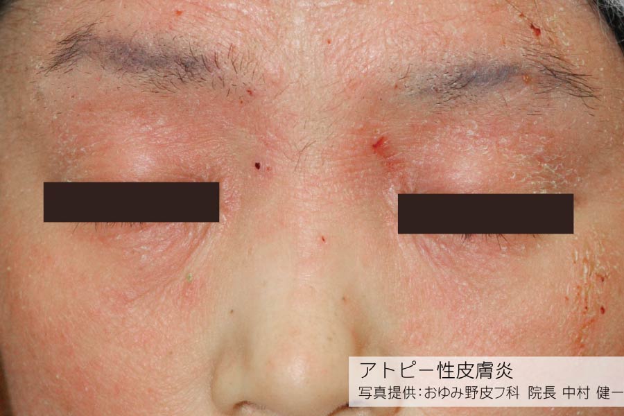 アトピー性皮膚炎