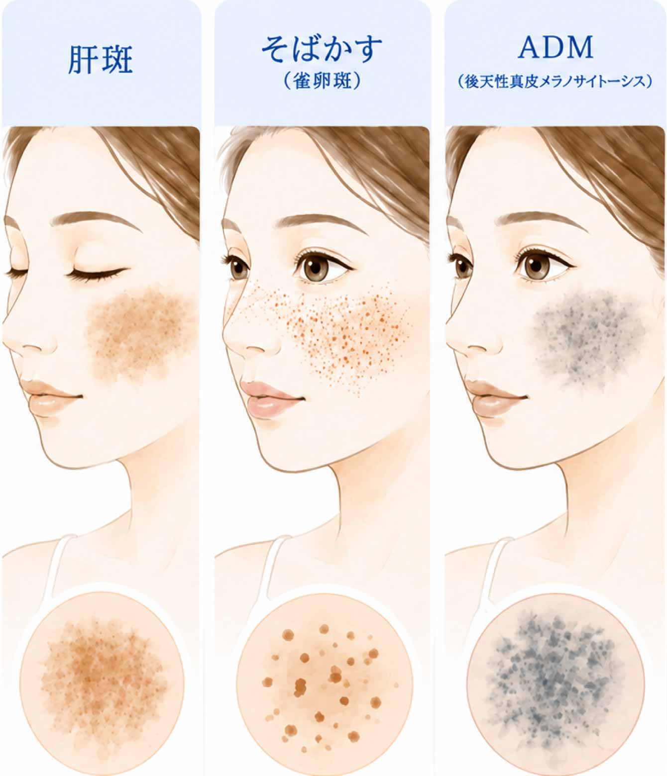 シミの種類