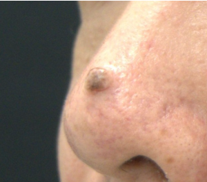 Miescher型の色素性母斑