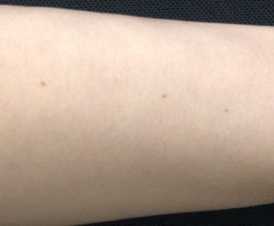 Clark型の色素性母斑